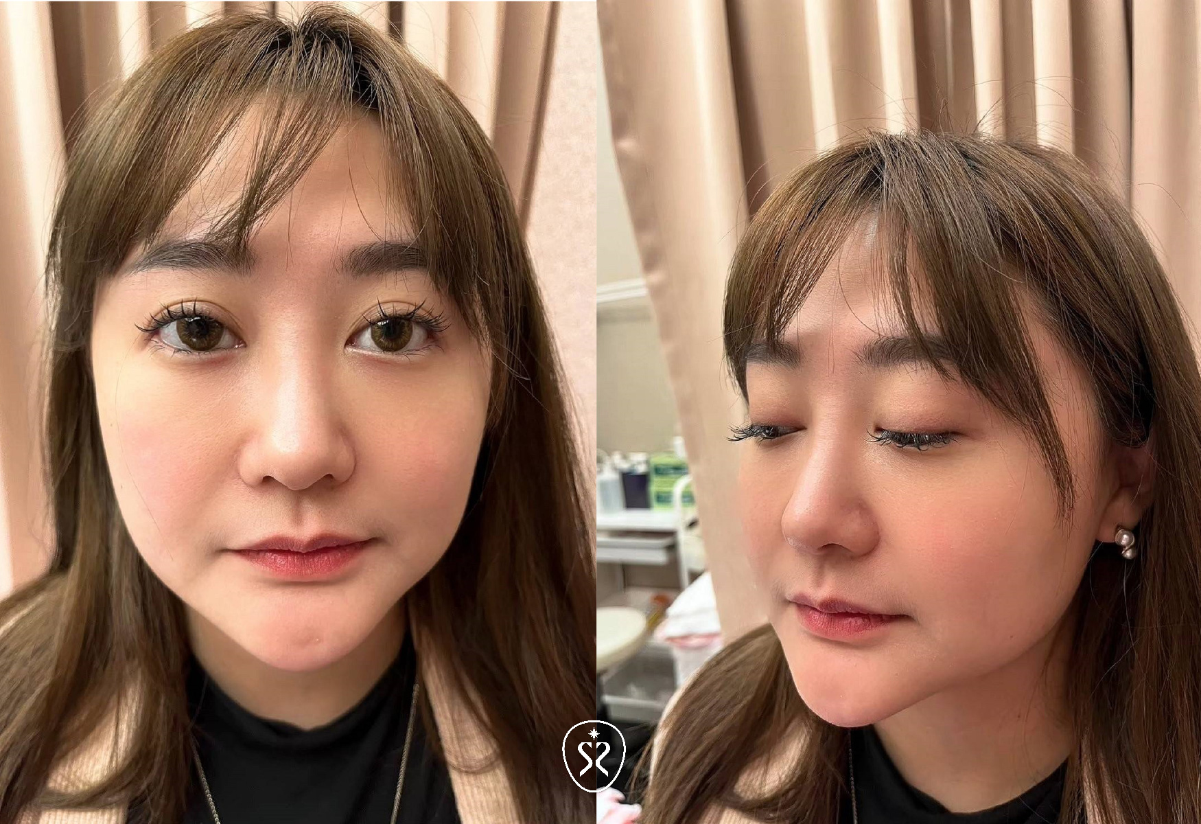 星和診所台中醫美玻尿酸豐唇療程分享